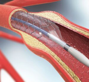 Čo je to koronarografia?